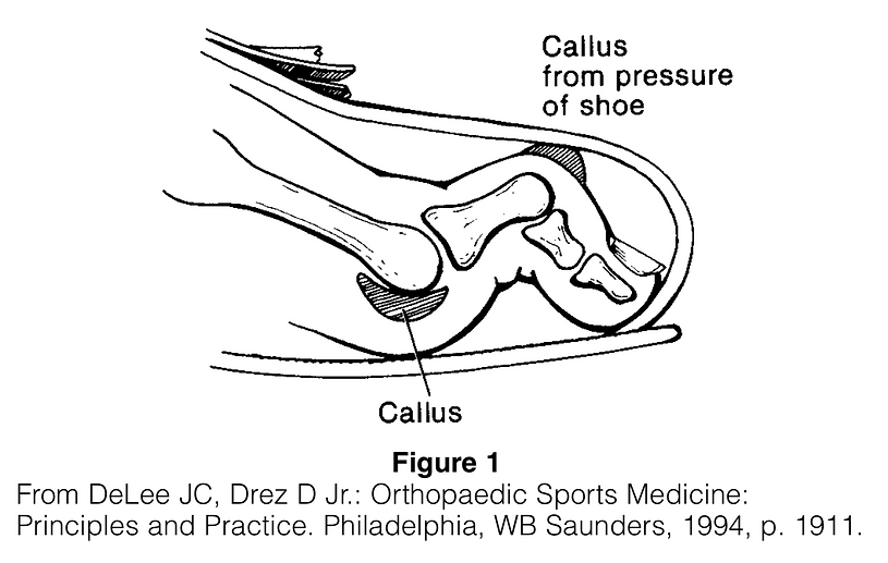 Corns and Calluses Lower Limb Surgery